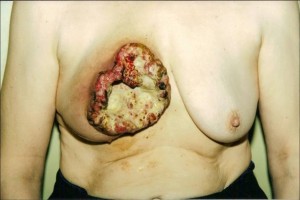 Последней стадии рака груди