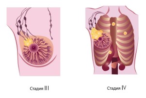 Стадии рака груди 3-4