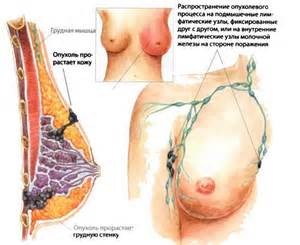 Рак груди 3 стадия