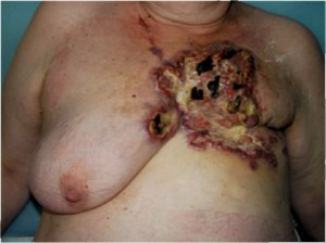 Рак груди 4 стадии